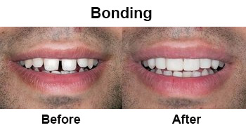 Before and After Bonding