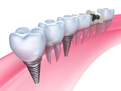 Dental Implants | Dentist in Rockville Centre, NY | Cosgrove Dental